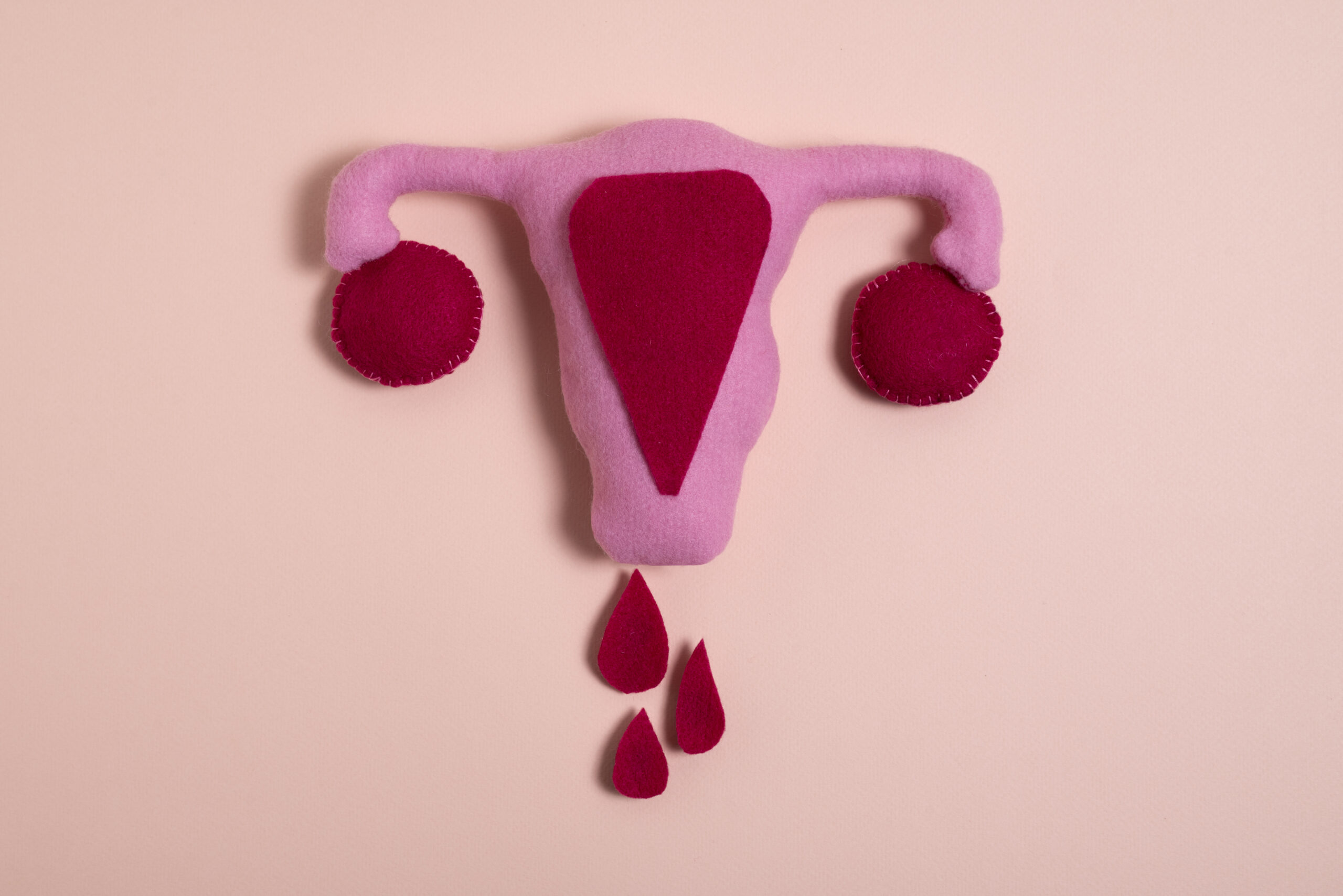 Menorrhagia